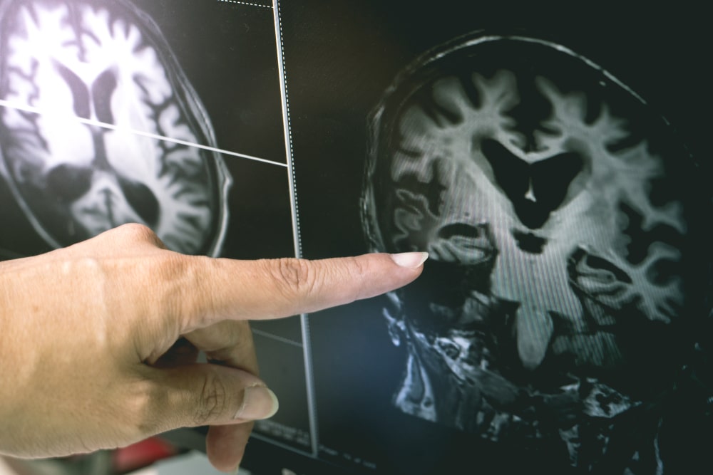 The Link Between Alzheimer's and Diabetes Explained